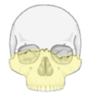 <p>What type of Le Forte fracture is this</p>