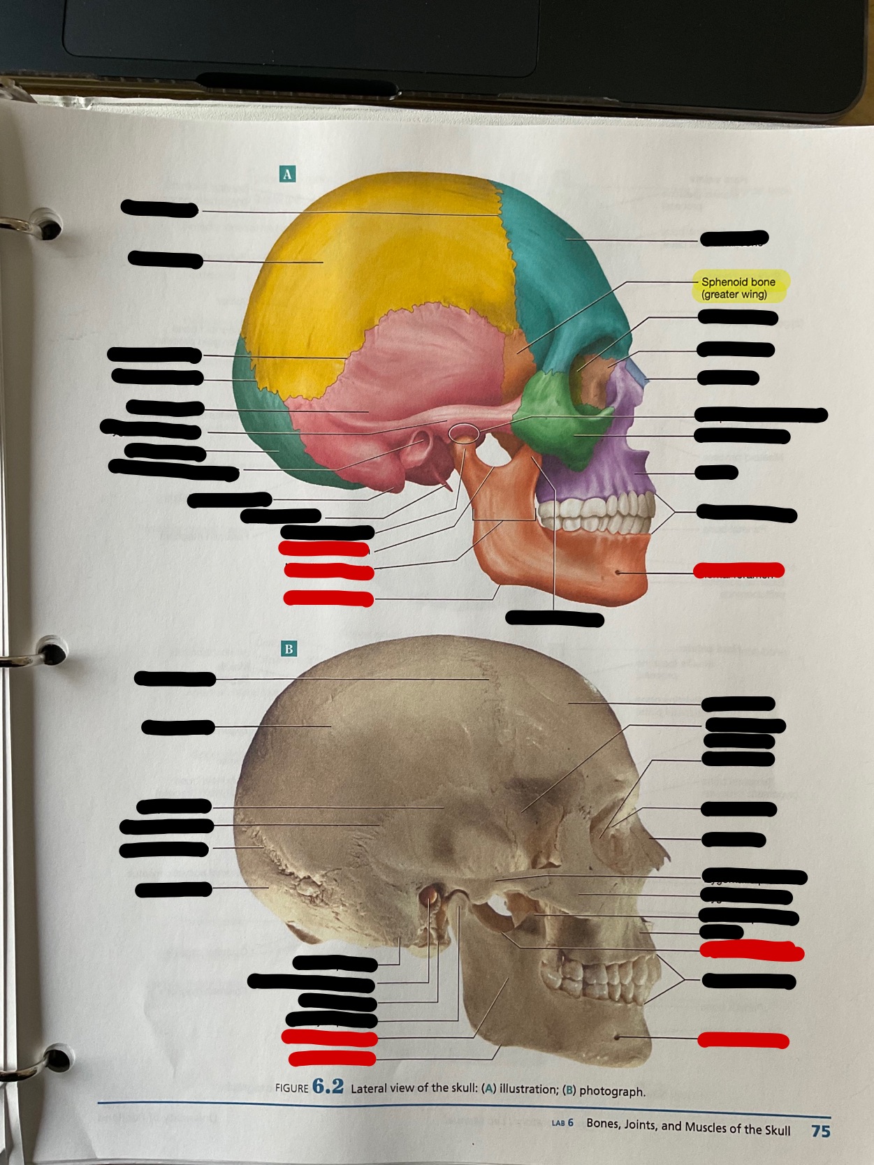 Sphenoid (greater wing)