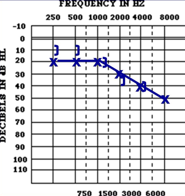<p>what kind of hearing loss is this </p><p>AC: </p><p>BC: </p><p>air bone gap? </p>