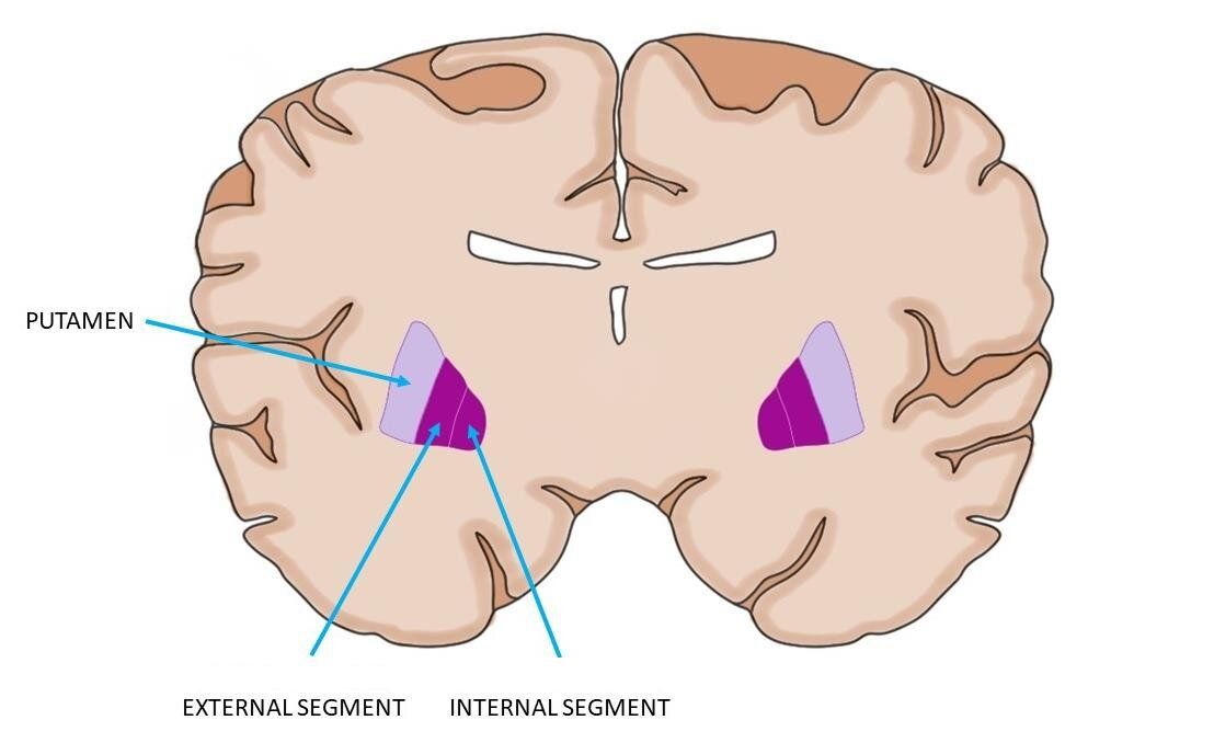 nuclei deep in the cerebrum that are part of the basal nuclei and can be divided into the internal and external segments