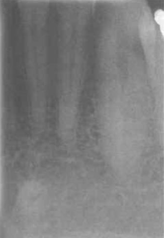 <p><span>may be seen as white</span><span style="color: red;"><span> radiopaque area with a small central radiolucent dot</span></span><span> in radiographs of the </span><span style="color: red;"><span>lower incisor area</span></span></p>