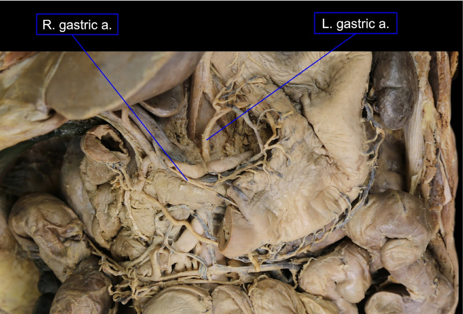 <p>A). left gastric artery<br>B). right gastric artery</p>