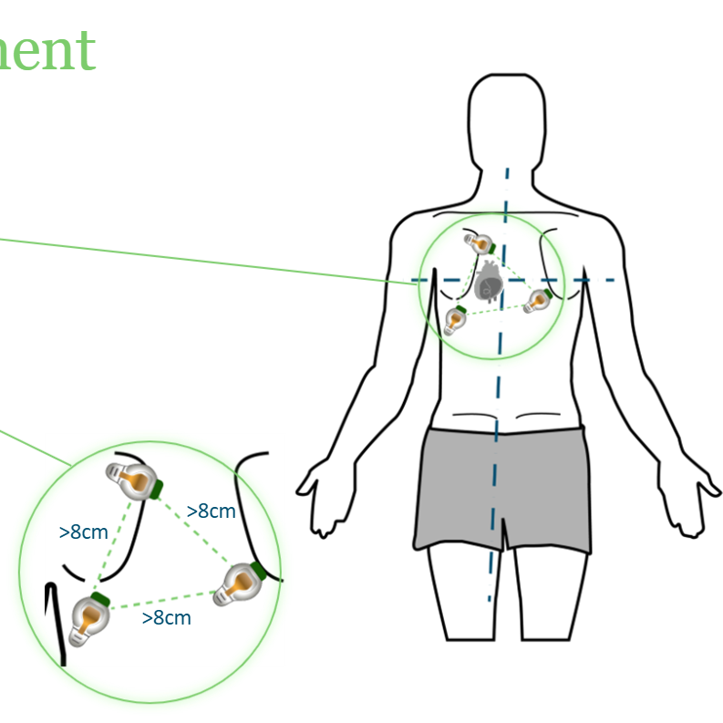 <p>PRS-P: In a triangular formation around the heart; 8cm away from each other</p>