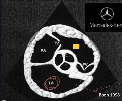 <p>Right Parasternal Short Axis View&nbsp;</p>