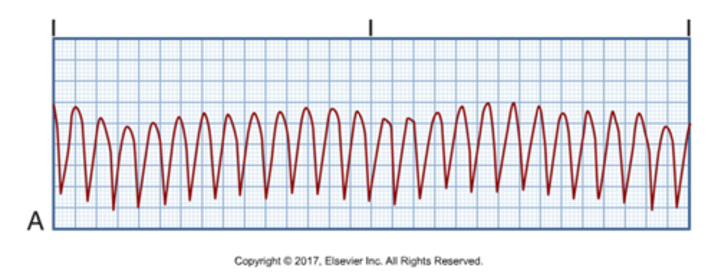 <p>QRS complexes that are the same shape, size, and direction</p>