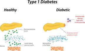 <p>DM Type 1 (Type 1 Diabetes Mellitus)</p>