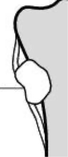 <p>what type of abnormal periosteum is this?</p>