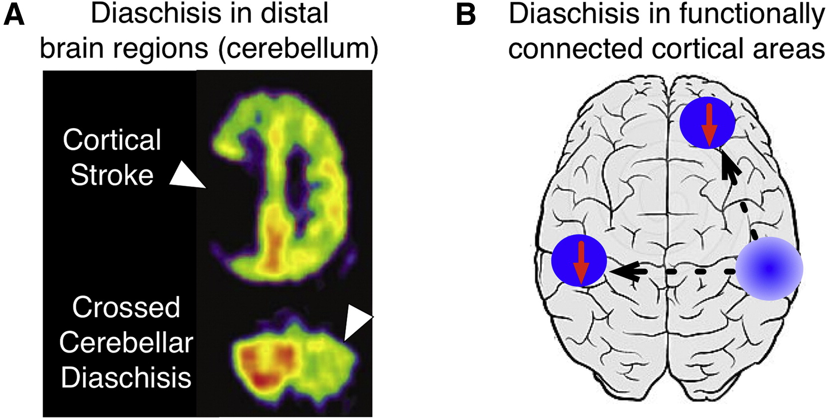 <p>diaschisis</p>