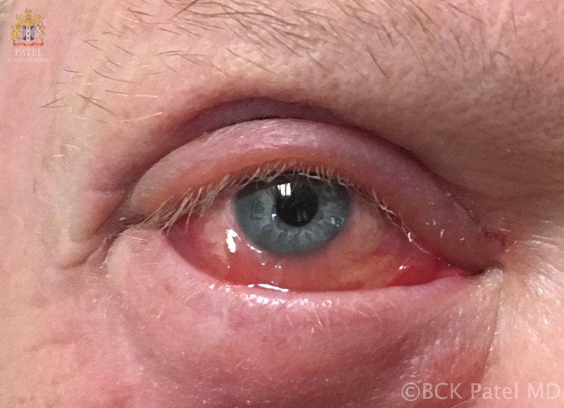 <ul><li><p><span>Oedema of the Conjunctiva</span></p></li></ul><p></p>