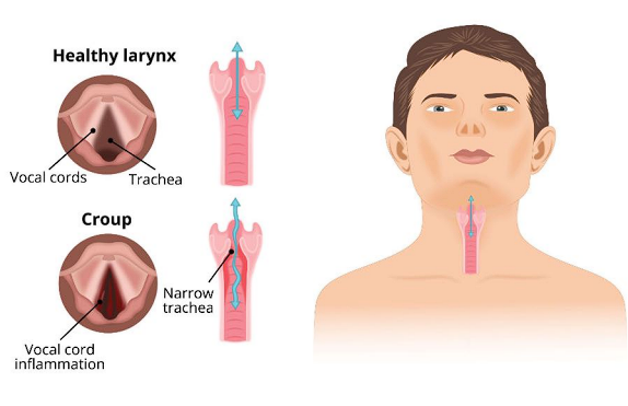 ● Laryngotracheobronchitis (LTB) 

● Viral respiratory tract illness  

○ Results in inflammation and  edema of the larynx and/or  trachea 

● Commonly affects pediatric  population 