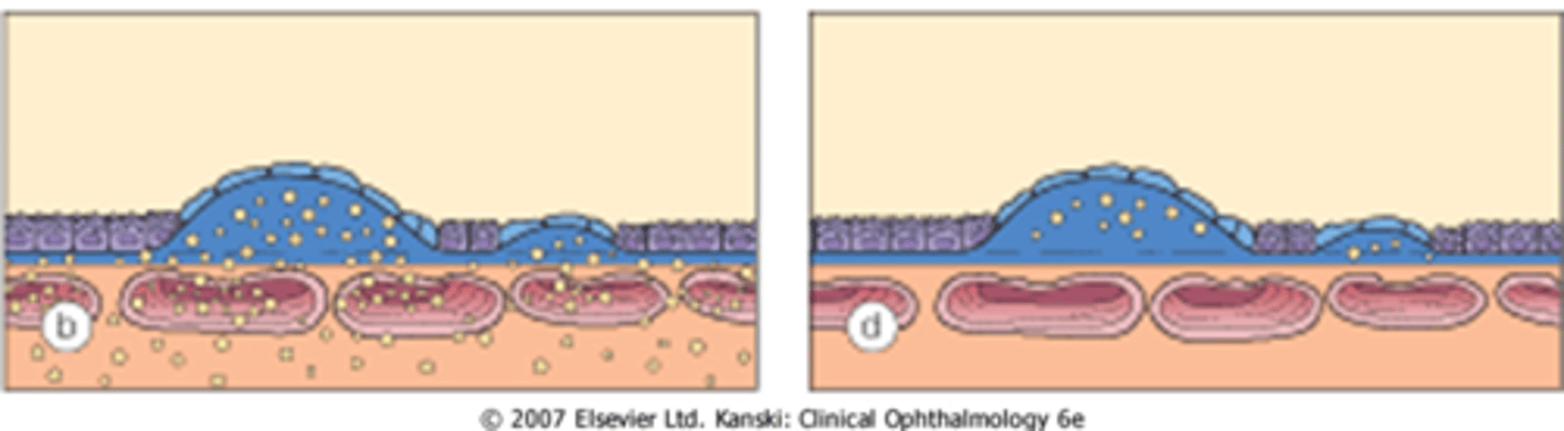 <p>compromised RPE metabolism = lipofuscin waste product buildup = Bruch's thickens, RPE thins = atrophic changes in retina, choriocapillaris</p>