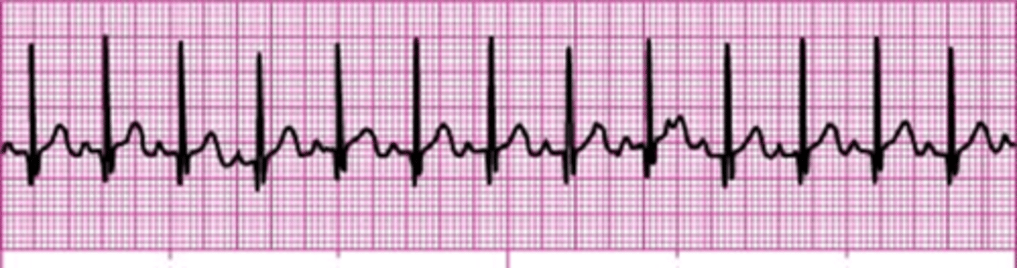<p>&gt;100 normal sinus rhythm</p>
