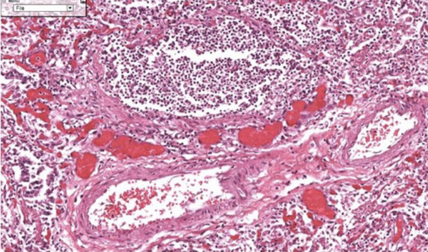 <p>What type of necrosis is seen here?</p>
