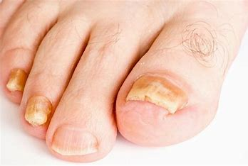 <p>nail thickening or hypertrophy caused by trauma, psoriasis, fungal infections, or PVD.</p>