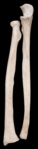 <p>Of these two bones, what is the lateral bone called?</p>