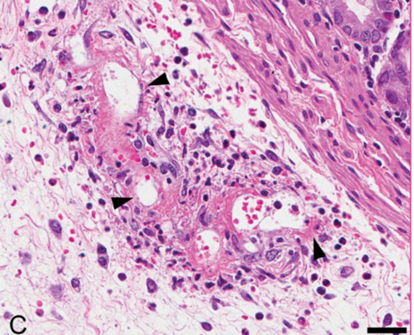 <p>describe the extracellular accumulation</p>