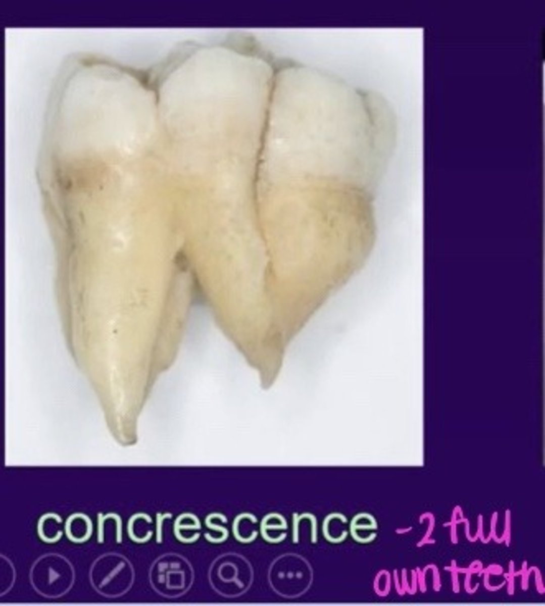 <p>Fusing of teeth at cementum</p>