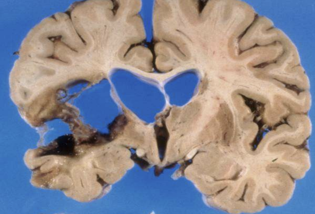 <p>Cells that do not proliferate ever (e.g., neurons, myocardial cells). Repairs damage with fibrous scarring, gliosis, etc but does not fully repair good as new. Never get the damaged cells back</p>