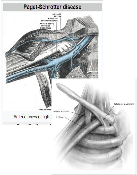 <p>PAGET-SCHROTTER DISEASE: “Effort Thrombosis” (5)</p>