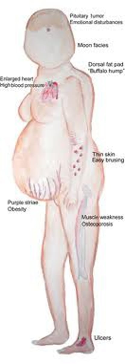 <p>Moon face, truncal obesity, buffalo hump, peptic ulcers, hypertension, low immune system</p>