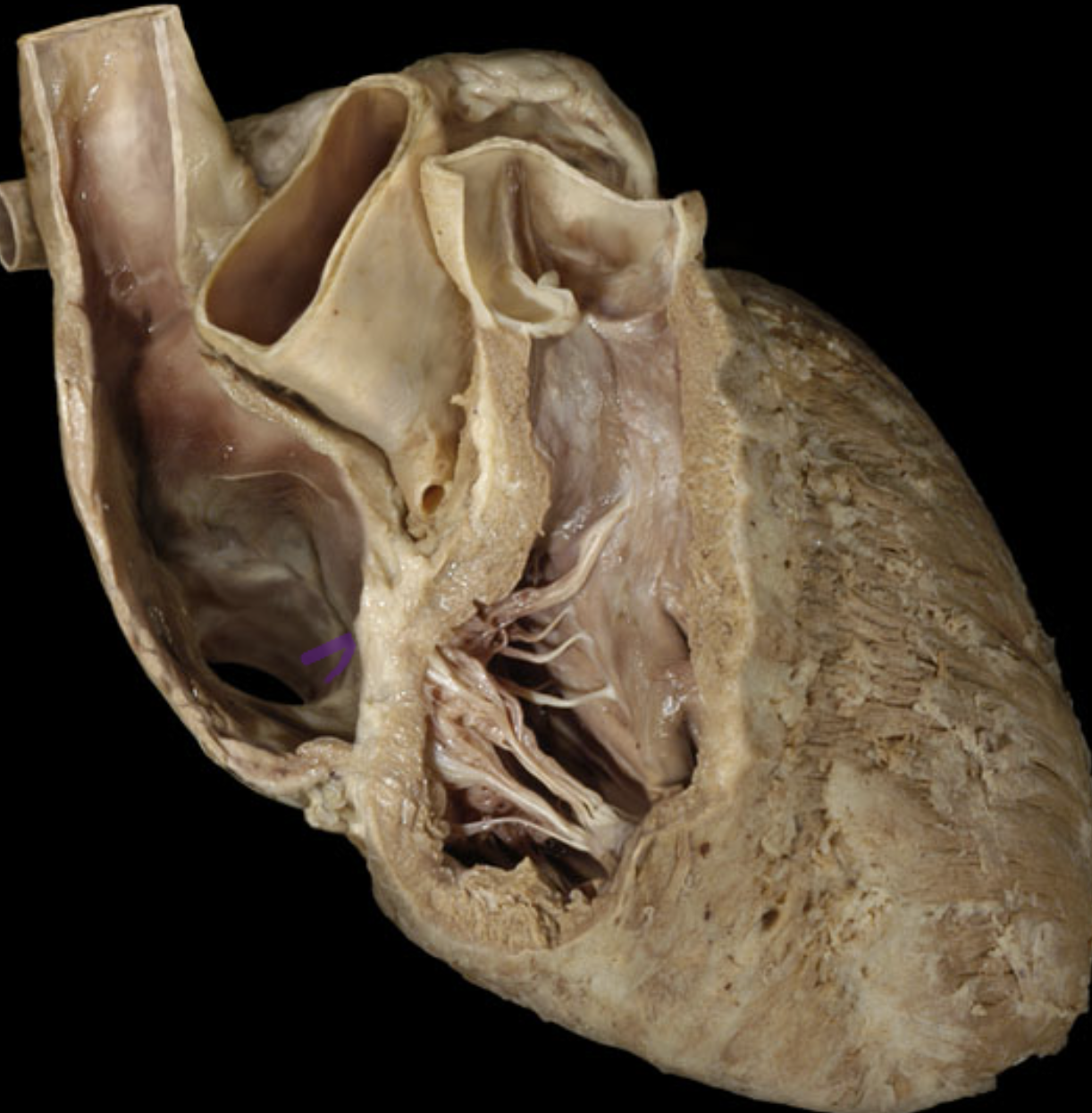 <p>Opening of coronary sinus</p>