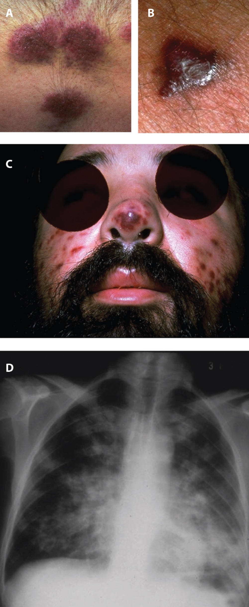 What are A-C photos of?

A. Cellulitis

B. Kaposi sarcoma

C. Positive TB test

D. Bullseye lesion