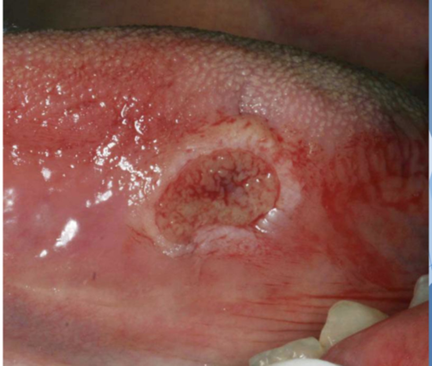 <p>Patient reported biting their tongue for the 5th time this week. What do you suspect?</p>