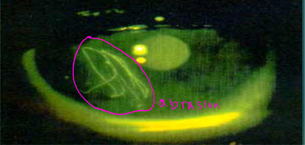 <p>Topical anesthetic for severe pain</p><p>Severe photophobia causing blepharospasm- (have someone hold eye open so you don’t have to use drops and wait) instillation of cycloplegic 20-30 minutes prior to exam&nbsp;</p><p>Fluorescein instillation and exam with blue light</p><p>Slit lamp- anterior chamber for evidence of iritis (cells and flare)</p>