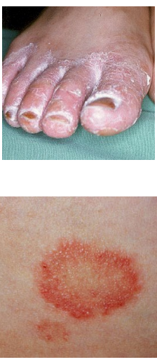 <p>Infection requires <strong>direct contact</strong> and a small <strong>break</strong> in the <strong>skin</strong> – common in <strong>feet</strong> and <strong>groin</strong><br>Age/site: Tinea <strong>capitis</strong> common in children; Tinea <strong>pedis</strong> common in adults<br>Lesions show <strong>ring</strong> pattern; spreads through <strong>stratum corneum</strong><br>Nail infection starts at <strong>lateral</strong> nail plates; hair infection may evade <strong>hair shaft</strong></p>