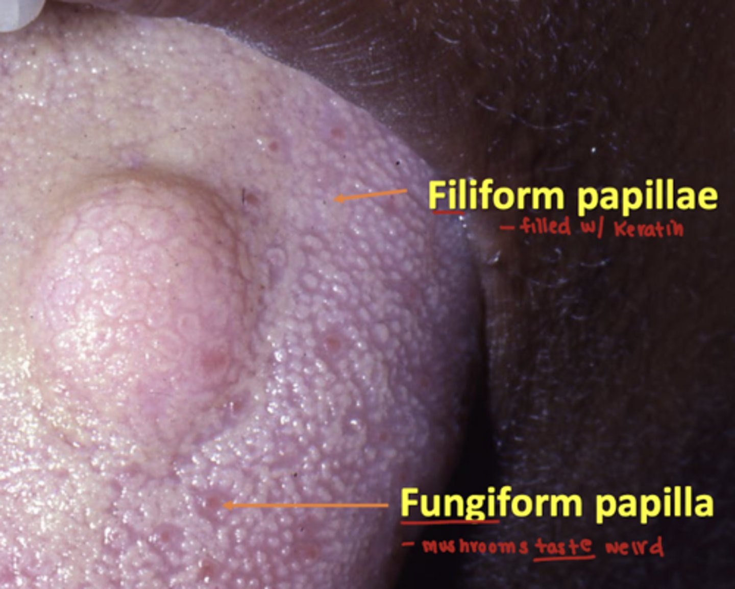 <p>fungiform: is non-keratinized and contain a few tastebuds</p><p>filiform: is keratinized </p>