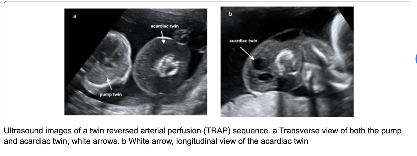 <p>a) twin reversed arterial perfusion sequence [<strong>TRAP</strong>]</p><p>b) twin anemia polycythemia sequence (<strong>TAP</strong>)</p><p>c) a triploidy fetus + normal fetus</p><p>d) vanishing twin syndrome</p>