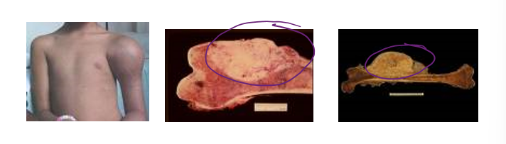 <p>homeostatic imbalance </p><ul><li><p>uncontrolled growth of malignant tissue </p></li><li><p>primarily in children and young adults </p></li></ul>