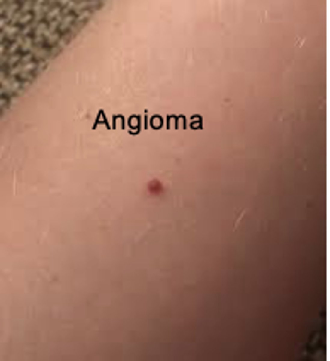 <p>A fiery red, marking with a solid circular center. With pressure, note blanching. Develops on face, neck, or chest.</p>