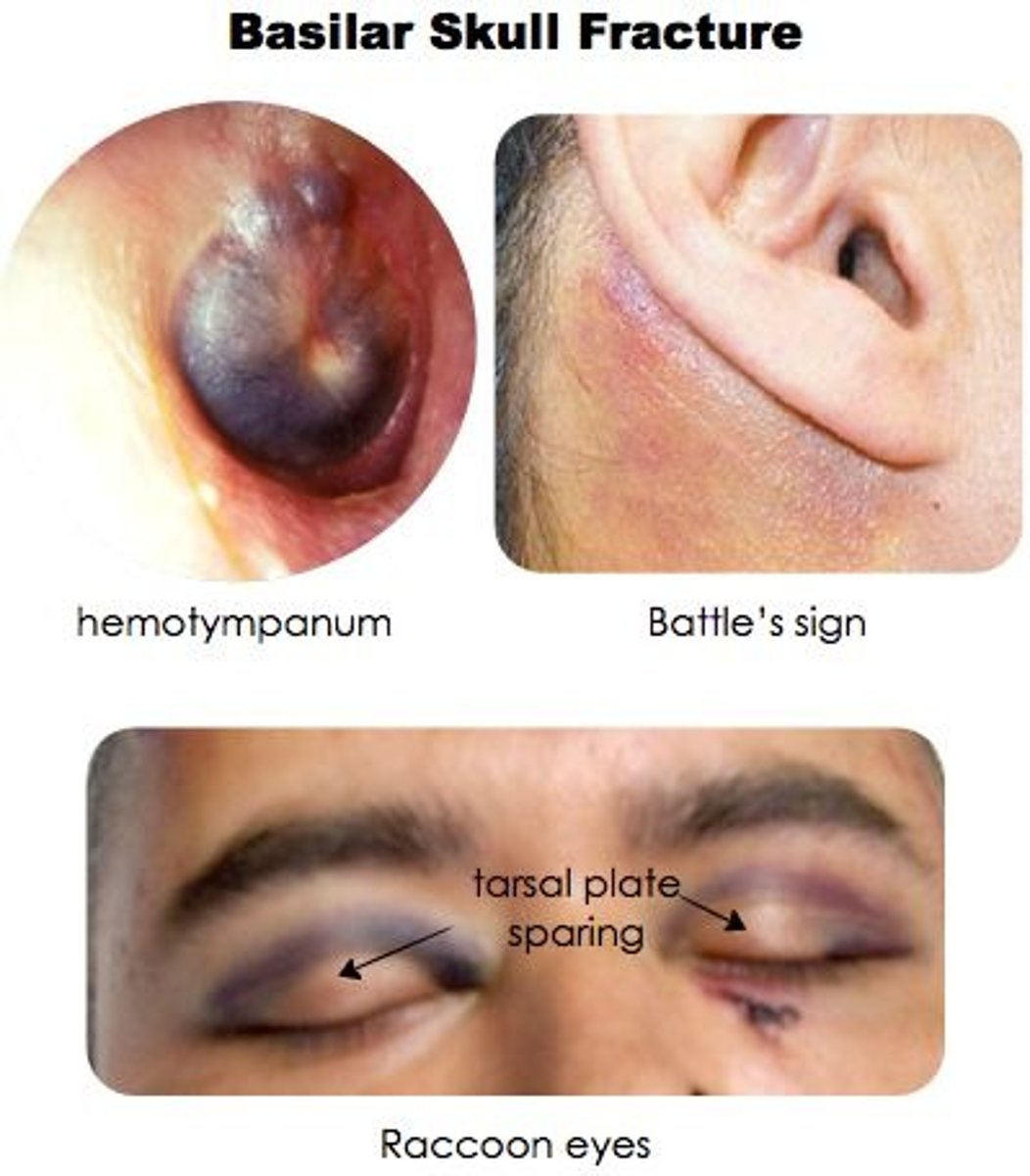 <p>Linear fracture that occurs at the base of the skull; CSF otorrhea/rhinorrhea, periorbital ecchymoses ("raccoon eyes"), retroauricular ecchymoses ("battle sign"), hemotympanum</p>
