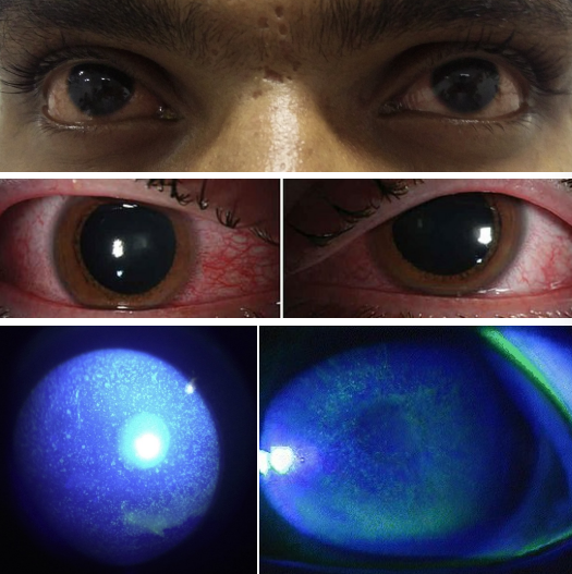<ol><li><p>Bilateral • </p></li><li><p>Mild eyelid edema, conjunctival injection </p></li><li><p> Assessment through slit lamp •</p><ol><li><p>Dense, confluent, punctate epithelial defects </p><ol><li><p>• (+) NaFl Staining •</p></li></ol></li><li><p> Mild to moderate corneal edema possible</p></li></ol></li></ol><p></p>