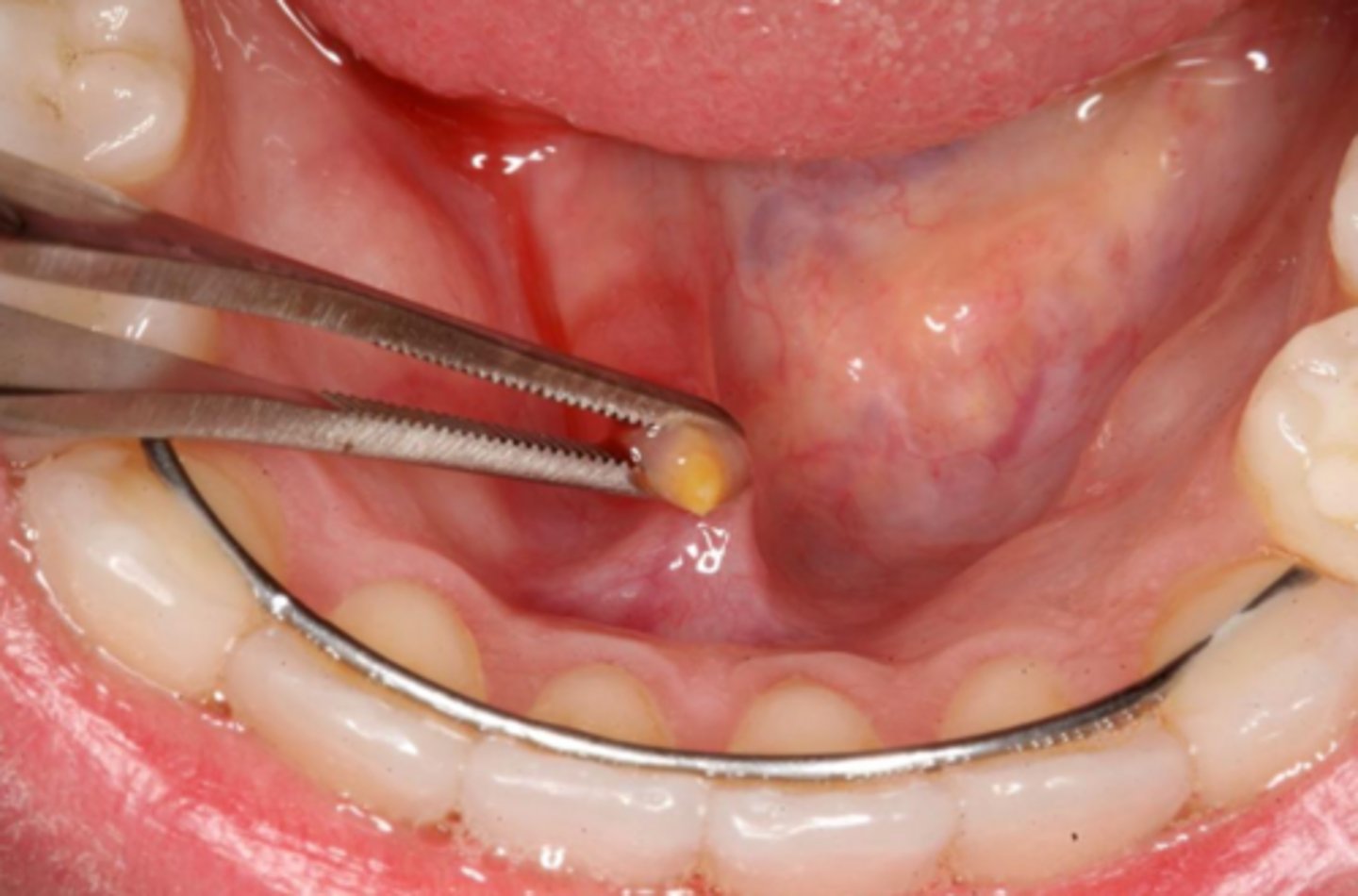 <p>sialolithiasis</p>