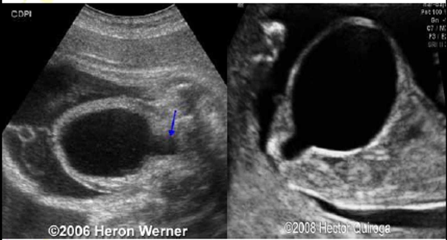 <p>Males. Keyhole sign, megacystis, bilateralhydroureter, hydronephrosis</p>