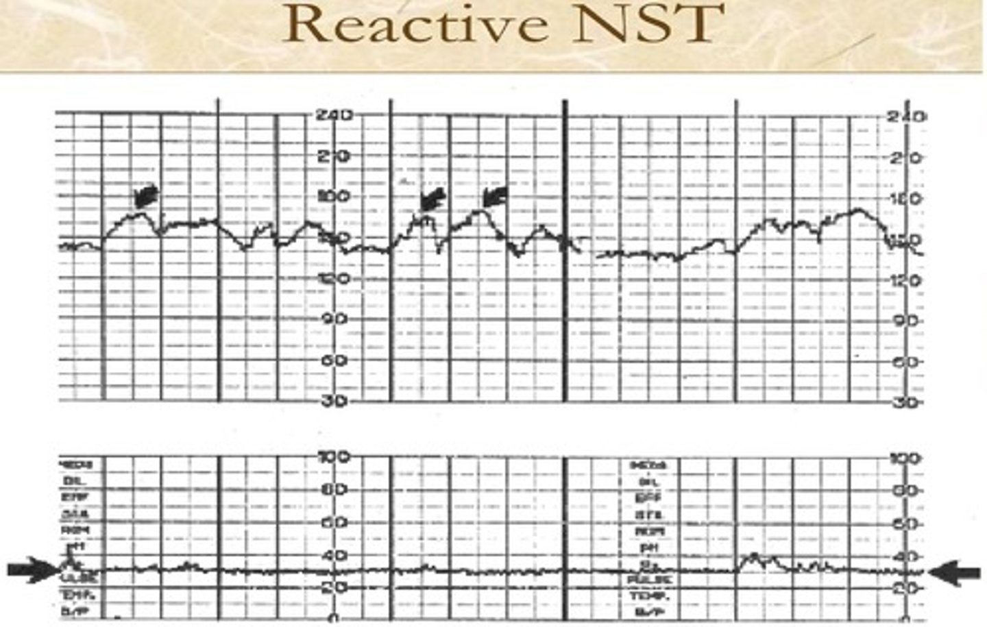 <p>- Non reactive stress test</p><p>- It is done for 20-40 minutes</p>