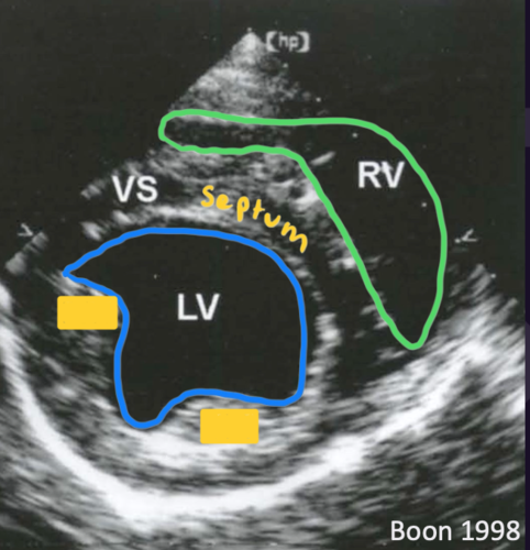 <p>Right parasternal short axis view</p>