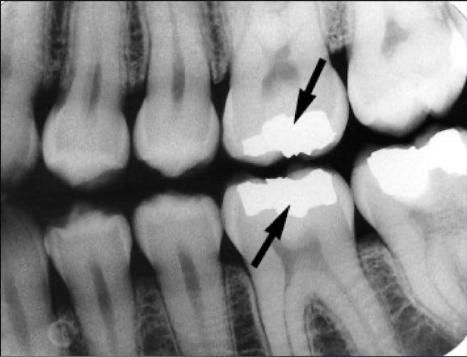 <p>which restorative material?</p>