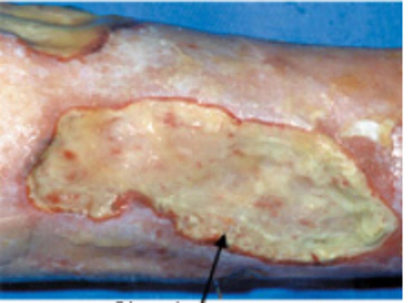 <p>WOUND BED ASSESSMENT</p><p>fibrin, degraded extracellular matrix proteins, exudates, white blood cells, and bacterial</p><p>*usually yellow/white color</p><p>**stringy, may be moist or dry; both have some degree of adherence</p><p>GET RID OF TO ALLOW WOUND TO HEAL</p>