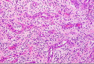 <p>proliferacja drobnych naczyń krwionośnych, fibroblastów i miofibroblastów, występują makrofagi i inne komórki zapalne oraz elementy tkanki łącznej takie jak włókna kolagenowe</p>