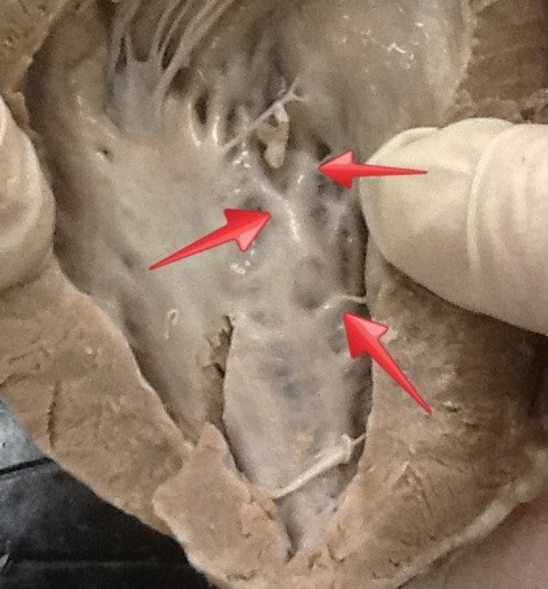 <p>muscular ridges on the internal surface of the ventricles</p>