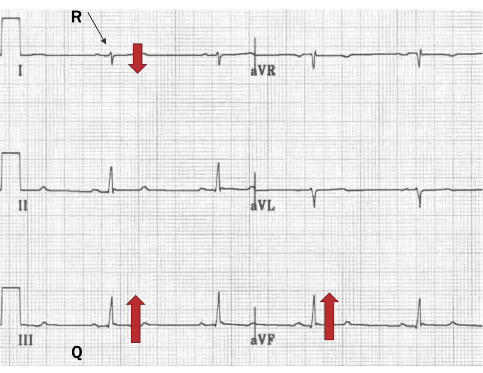 <p>RAD- neg I and pos aVF</p><p>R wave in I and Q wave in III- r1q3</p><p>mostly pos III</p>