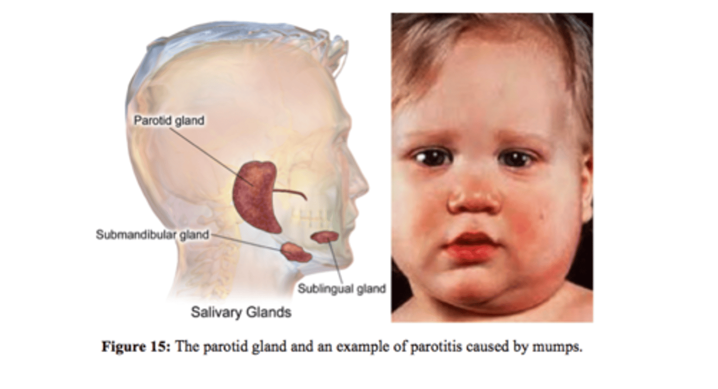 <p>Swollen parotid glands above jawline</p><p>- painful chewing</p><p>- causes orchitis (swollen testes)</p><p>Droplet precautions</p>