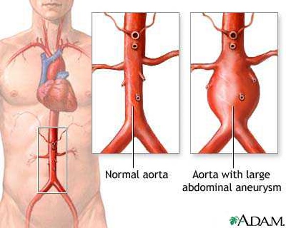 <p>My grandfather had two abdominal aortic aneurysms as pictured above.</p><p>The aorta is prone to blockages because it is a high pressure vessel.</p><p>They were treated with an endovascular graft.</p>