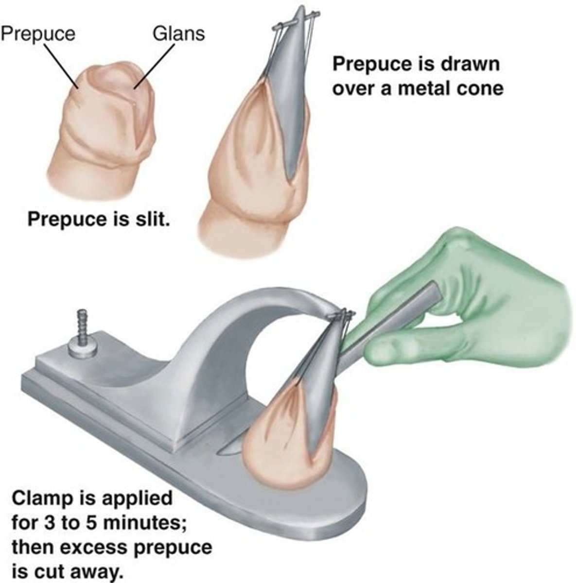 <p>the surgical removal of the foreskin (prepuce) of the penis</p>