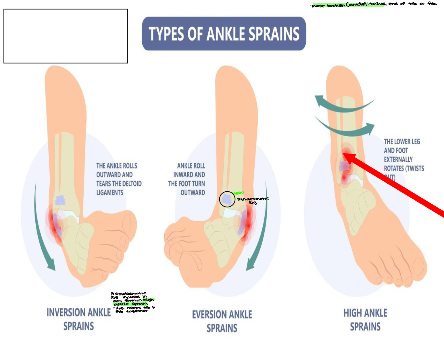 <ul><li><p>Most broken (ankle): <strong><em>talus</em></strong>, end of tib. or fib.&nbsp;</p></li><li><p>Syndesmotic lig. injured in any form → <strong><em>high ankle sprain&nbsp;</em></strong></p><ul><li><p>ligament keeps tibia and fibula together&nbsp;</p></li></ul></li><li><p>Don’t confuse high ankle sprain with broken ankle&nbsp;</p></li></ul><p></p>