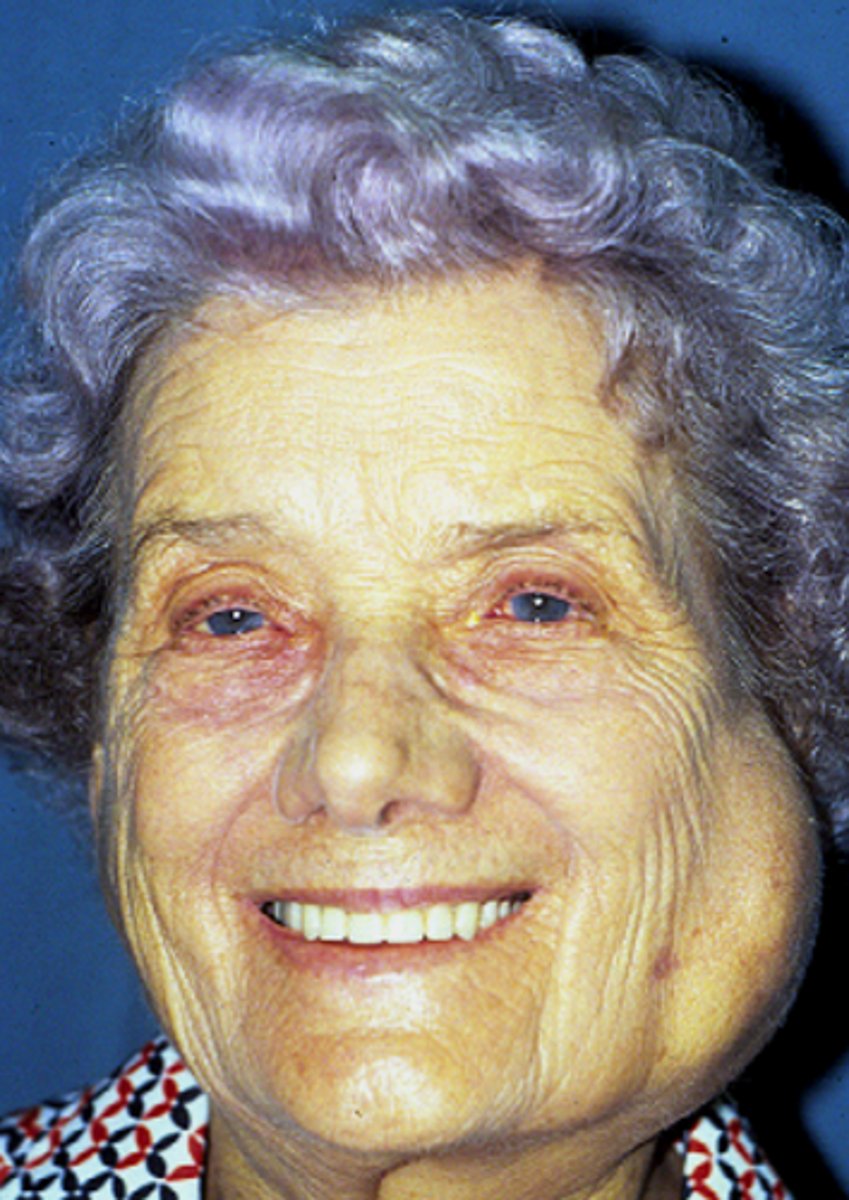 <p>Autoimmune disease, Enlargement of the salivary</p><p>glands</p>