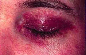 <p>What DM skin finding is being described?</p><ul><li><p>Erythematous/violaceous eruption on periorbital skin</p></li><li><p>± eyelid edema</p></li></ul><p></p>